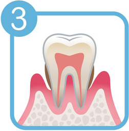 歯周病の症状3