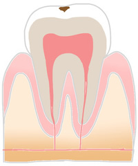 虫歯の症状1
