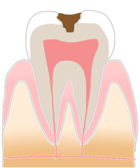 虫歯の症状2