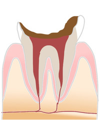 虫歯の症状4