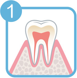 歯周病の症状1