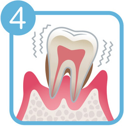 歯周病の症状4